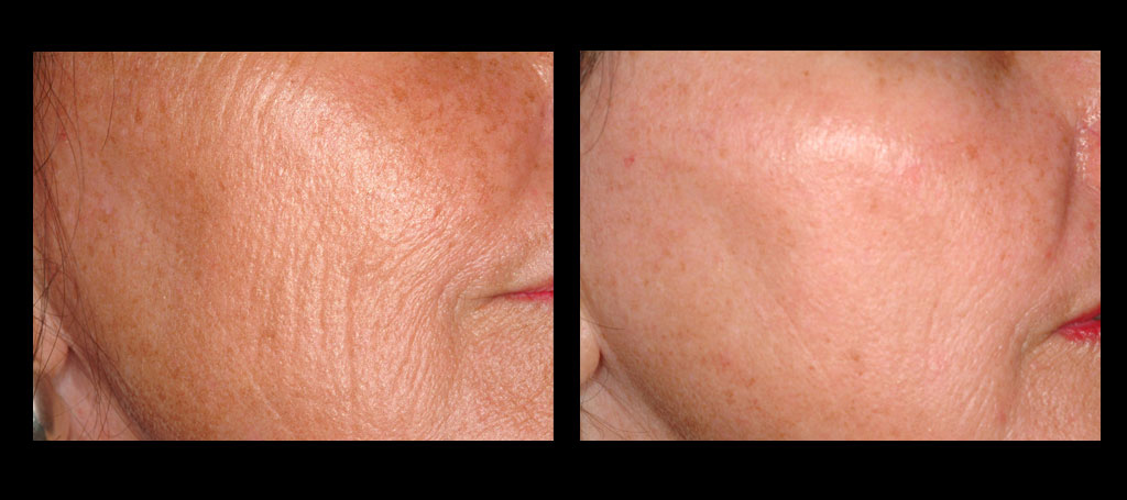 Falten (Skinresurfacing) Behandlung in Winterthur Sanabelle Laserzentrum